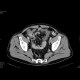 Crohn's disease with absesses, fistulae, and sacroileitis: CT - Computed tomography